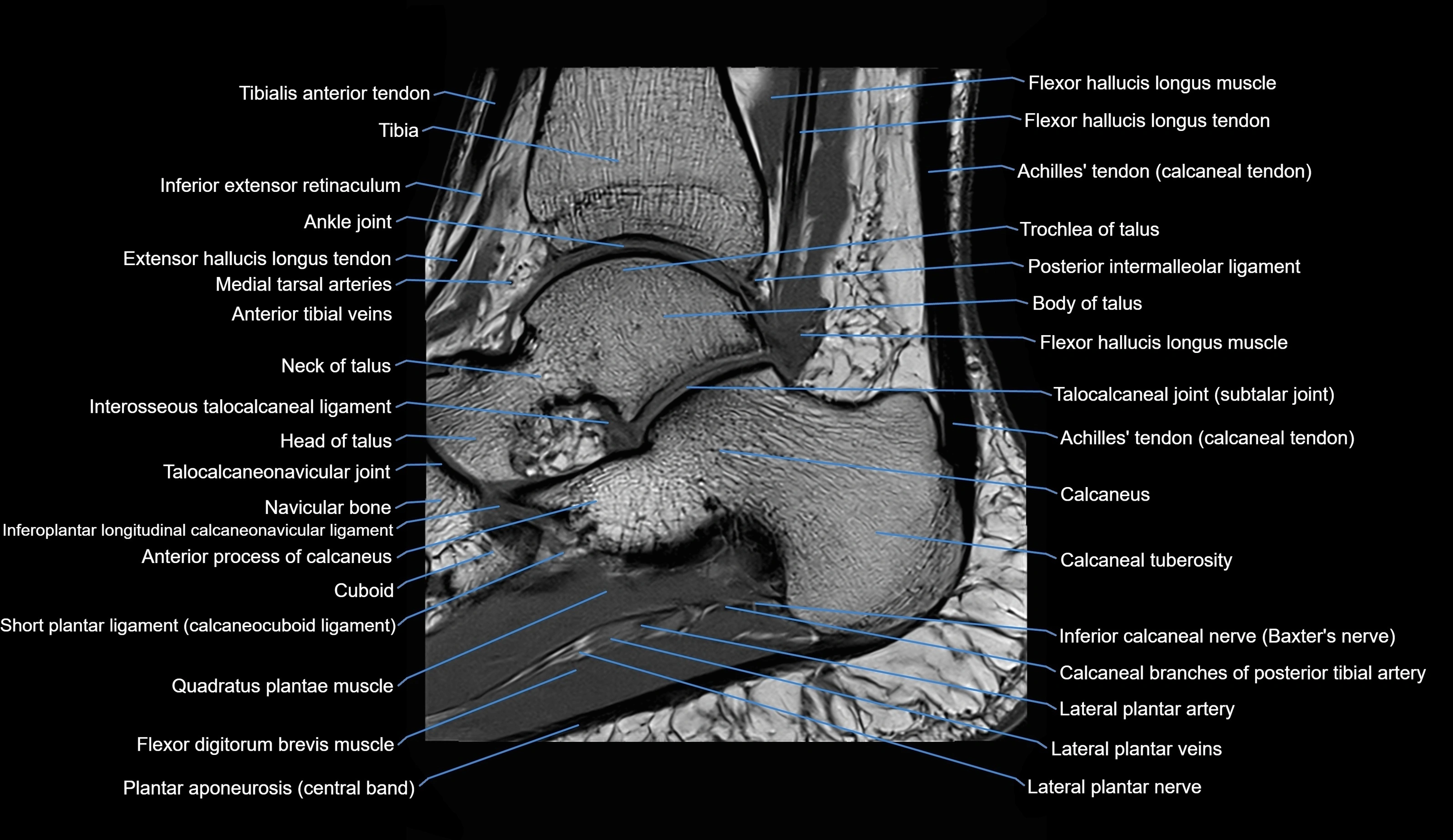 MRI Ankle sagittal cross sectional anatomy 3T  radiology  image-img-00001-00017.webp